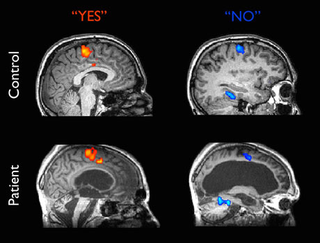 Illustration for article titled The neuroscience of comas, or what it means to be trapped inside your own mind